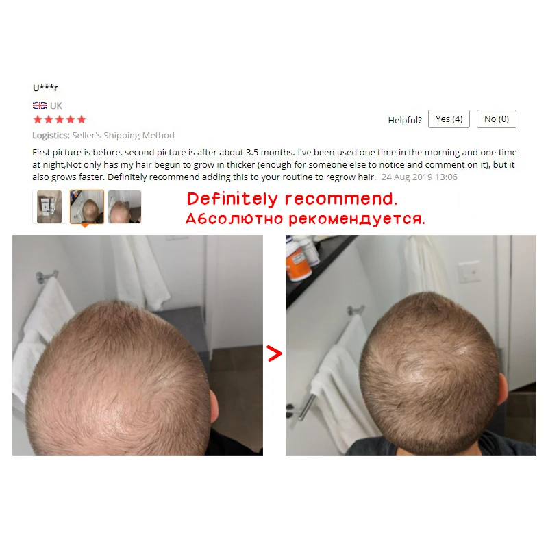 OEM лучшее средство для лечения выпадения волос для мужчин OMY LADY 100% натуральное имбирное масло для роста волос образец