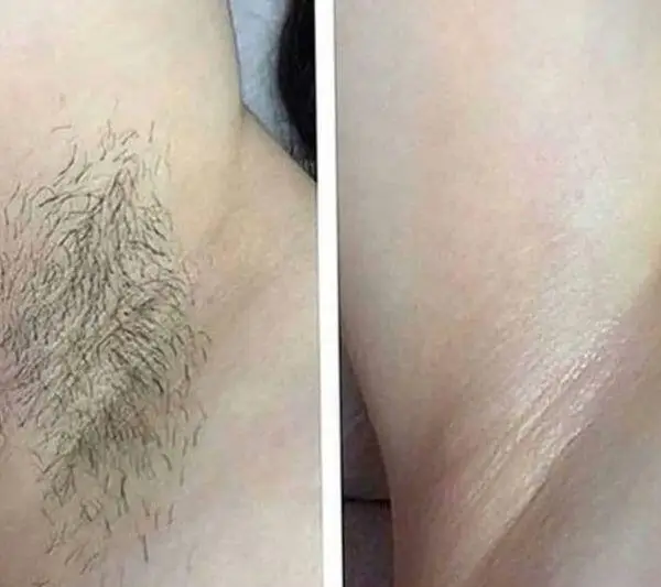 Home Use Portable Products 808 Diode Laser Hair Removal Permanent Machine For Personal Use