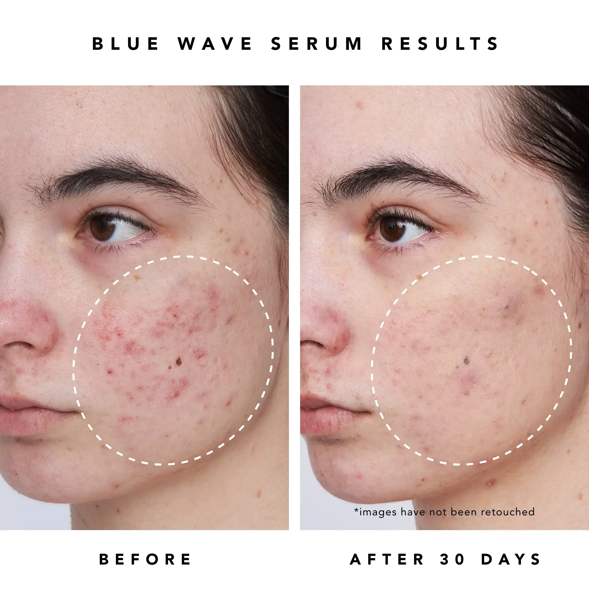 Private Label Skin Care Serum 2% Salicylic Acid Reduces Acne Fades Acne Scars Soothing Repairing Blue Wave Clearing Serum