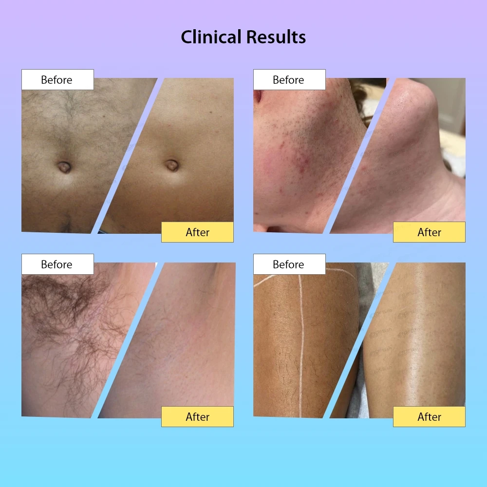 Painless new type 3 wellen dioden laser 808 755 1064 machine