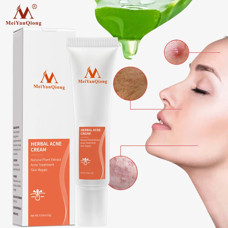 herbal acne removal face cream anti acne treatment cream skin care anti inflammatory lotion face cream