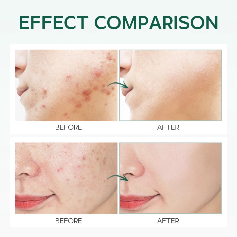 Wholesale Facial Moisturizing Skin Care Product Tea Tree Essence Anti Acne Removal And Skin Repair Face Cream