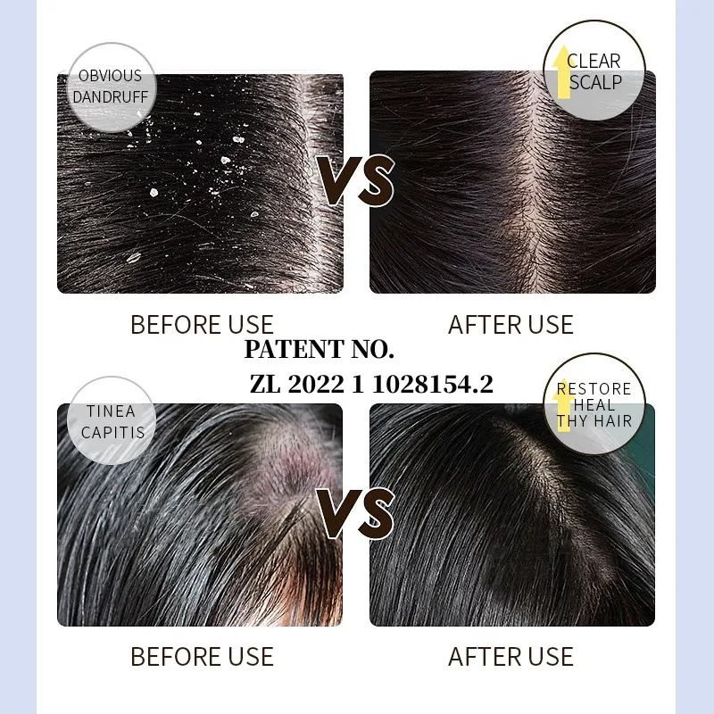 OEM/ODM shampoo and conditioner treat for tinea capitis scalp psoriasis malassezia folliculitis treatment for all types of hair
