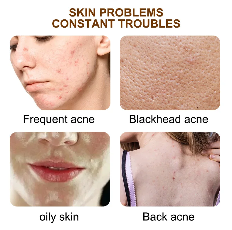 Acne Treatment Cream Anti Acne Face Cream Pimple Removal Spots Oil Control Shrink Pores Moisturizing Skin Care Cream