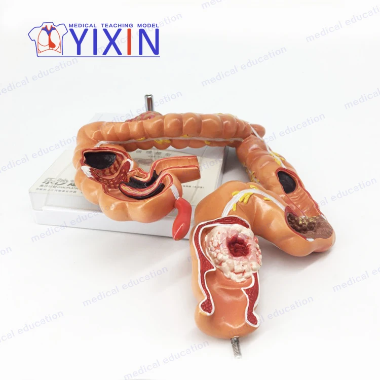 
YIXIN/Model of human colon disease Model of large intestine Pathological,Disease Large Intestines 