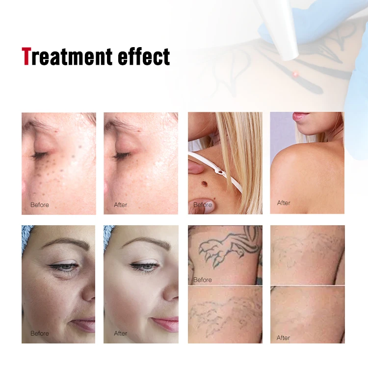 High quality fast delivery ND YAG Laser black doll machine carbon laser facial machine tattoo remover machine