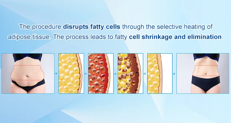 Best Selective radio frequency weight loss field Tuning real-time monitoring slim machine