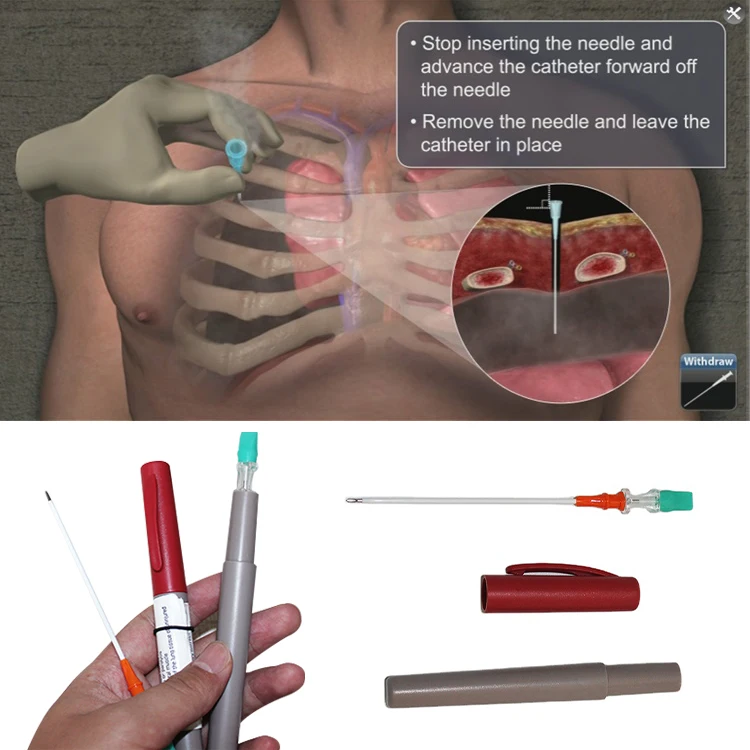 Medresq Factory Supply IFAK Tactical disposable Sterile 14Ga Chest Tension Decompression Needle for EMS