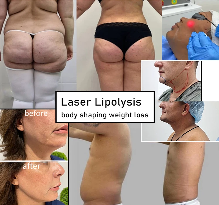 Professional medical 980 laser liposuction laser lipolysis endolaser 1470nm laser fiber face lifting beauty machine