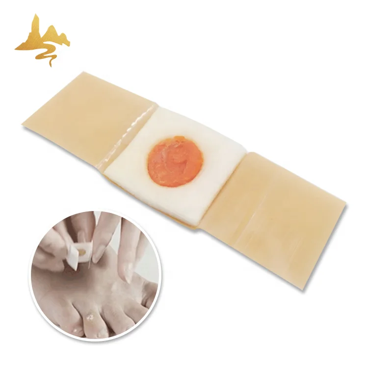 OEM Service Herbal Patch Foot Pain Relief Salicyl Acid Corn Wart Removal Plaster