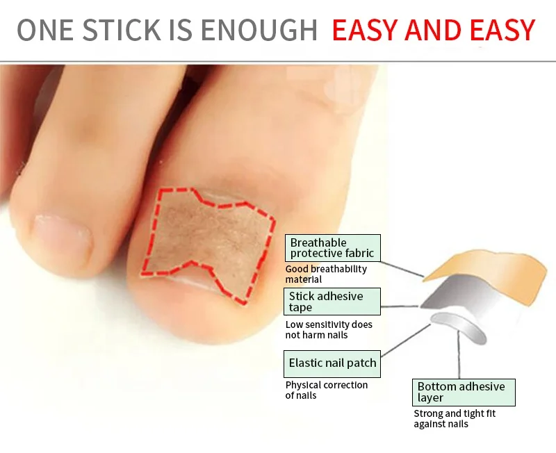 10 PiecesIngrown Foot Care Toenail Corrector Patch Nail Healing  High Elasticity Glue Free Corrector Treatment Tool