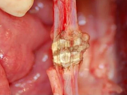 electrosurgical bipolar clamp ligasure vessel sealer
