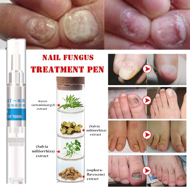 Nail Treatment From Fungus on Feet and Hand Disinfection Nail Fungal Treatment Oil Pen Manicure Treatment Tools