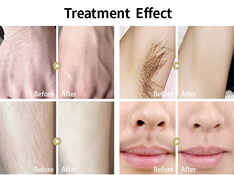 Professional high end 3 wavelength 755+808+1064 nm  diode laser hair removal machine