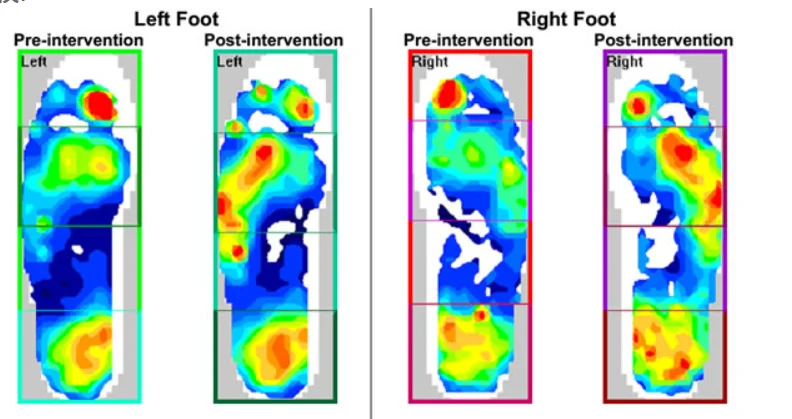Multi-area foot pressure distribution thermogram smart insole flat film pressure sensor