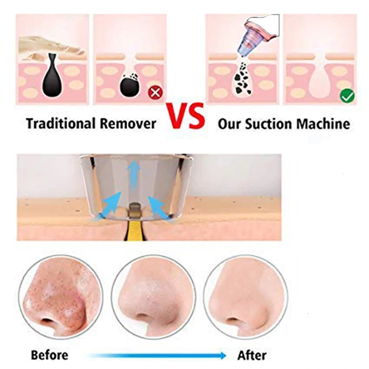 pore cleaner vacuum,extractor black head remover tool, portable facial cleaner pore vacuum blackhead remover vacuum 3 adjustable