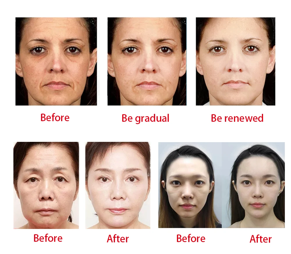 Medical Clinic 21g 60mm Hilos Barbed Tensores Wires Pdo Lift Nose Thread Cog