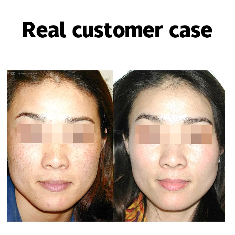 
OEM/ODM Custom pure natural herbal plant remove freckles remove dark spots whiten facial skin mask 