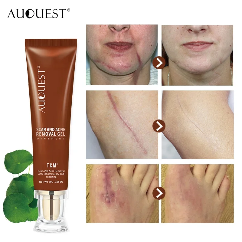 Professional facialtcm scar and acne mark removal gel ointment best south korea acne scar removal