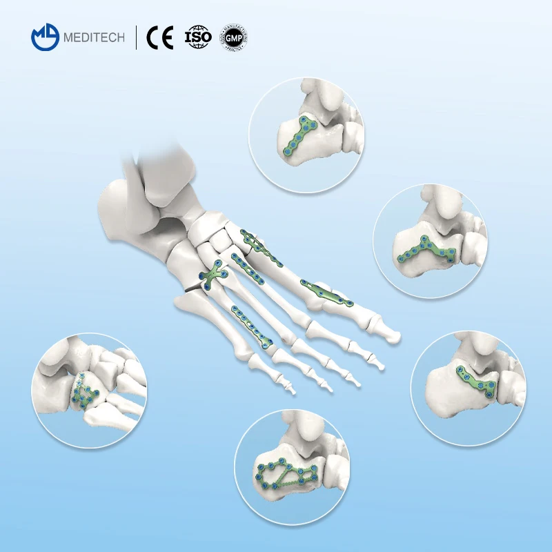 MEDITECH 2.7/3.5mm Foot And Ankle Plate Ankle Fusion Plate Orthopedic Locking Plates,Titanium Implant