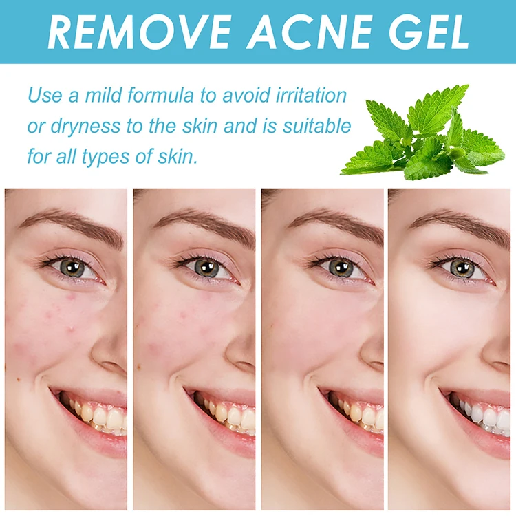 Cleaning Repair Pimples Smooths Skin Face Acid Gel Shrinks Pores Treatment Acne Salicylic Acid Gel
