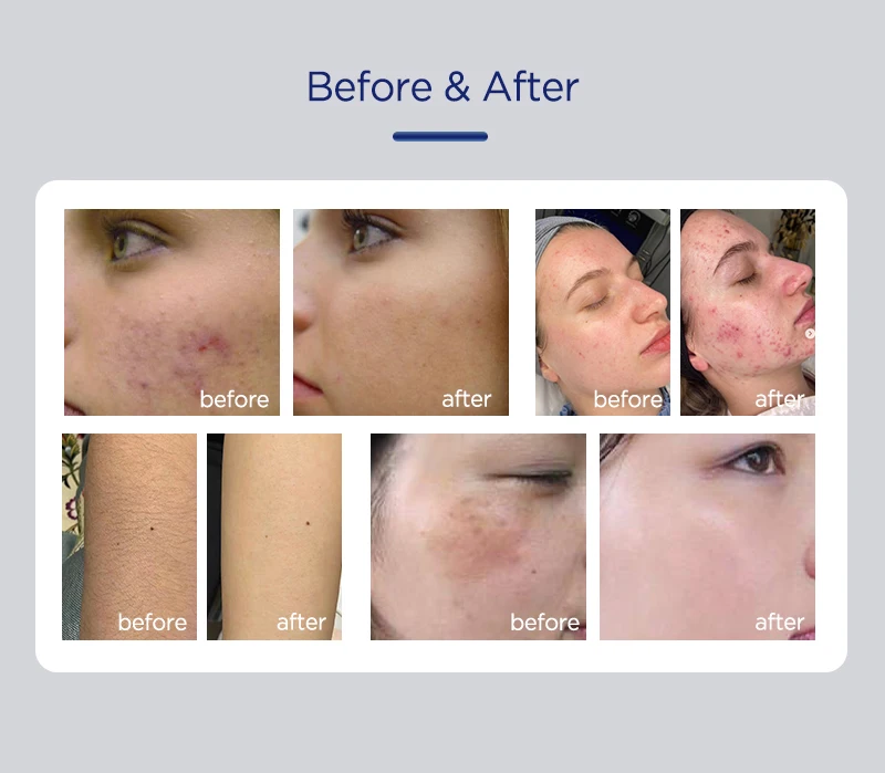 ADSS IPL pigment removal breast enhancement Beauty Machine IPL