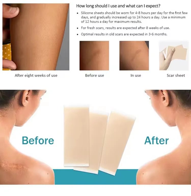 Manufacturer Customized Soft Silicone Gel Scar Patches Tape Self-adhesive Scar Patch Wound Plaster
