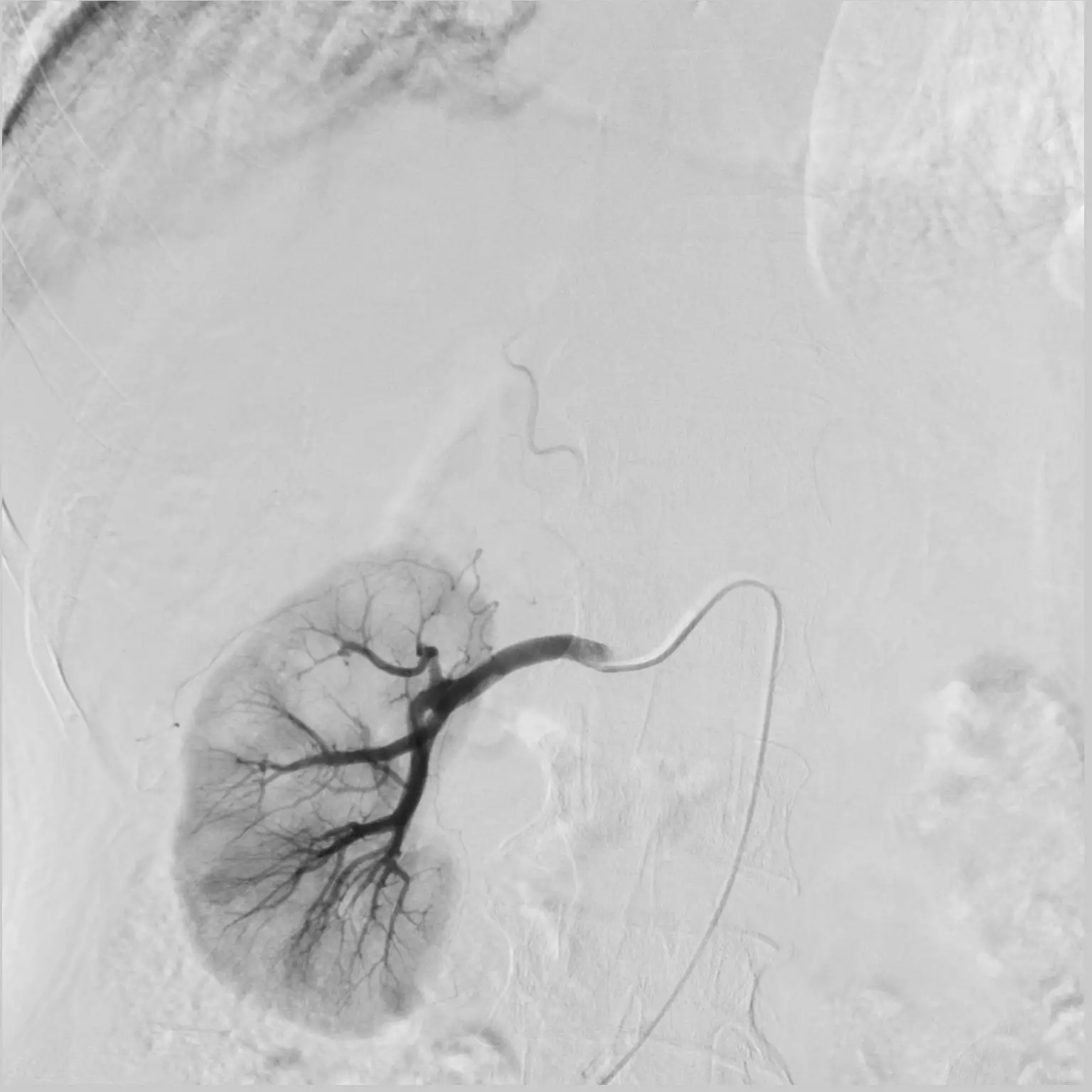 C arm x ray machine for neuro cardiac peripherial  angiography machine with liquid metal bearing x ray tube