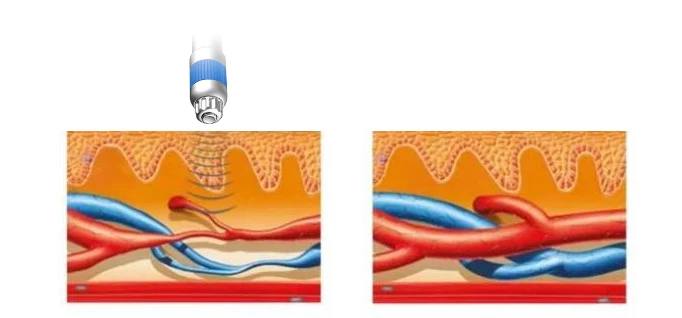 OEM ODM Shock Wave Therapy ED Extracorporeal Shockwave Therapy for Penis