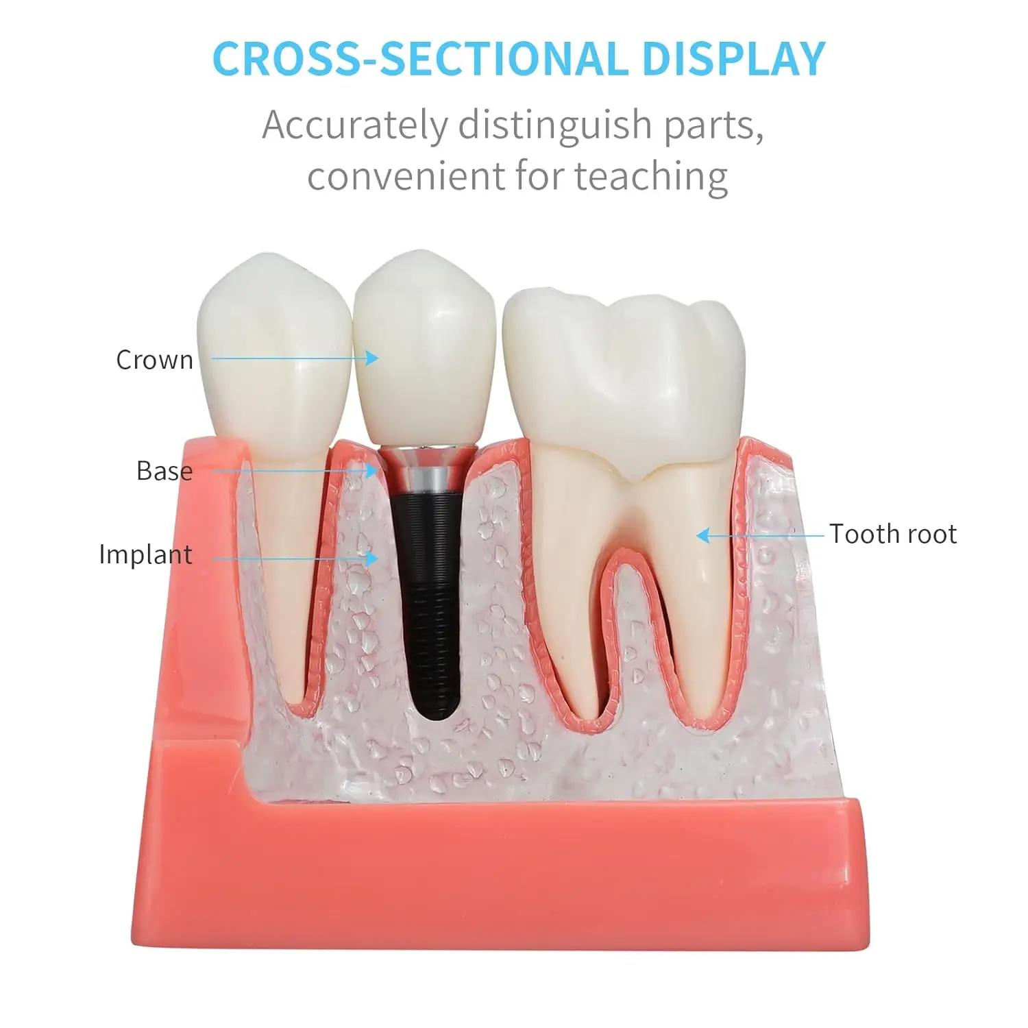 Dental Implant Model with Removable Analysis Crown Bridge Demonstration Teeth 4 Times for Medical Science Education Studying