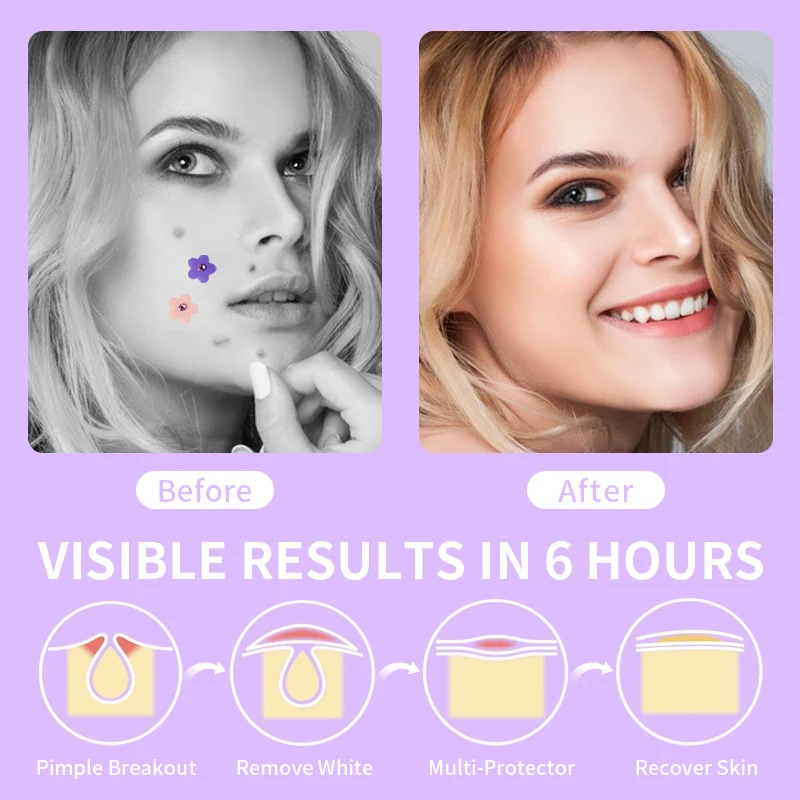 Customized Shape Colorful Stars Hydrocolloid Acne Blemish Pimple Patches Acne Patches Private Label