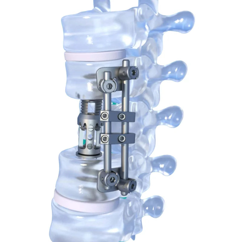 High-quality FAVA artificial vertebral body kit system