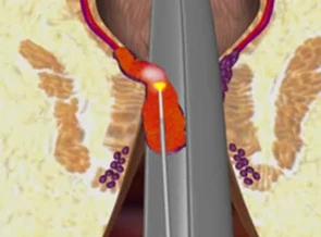 980nm Surgical piles laser for hemorrhoids and fistulas 1470nm laser diode