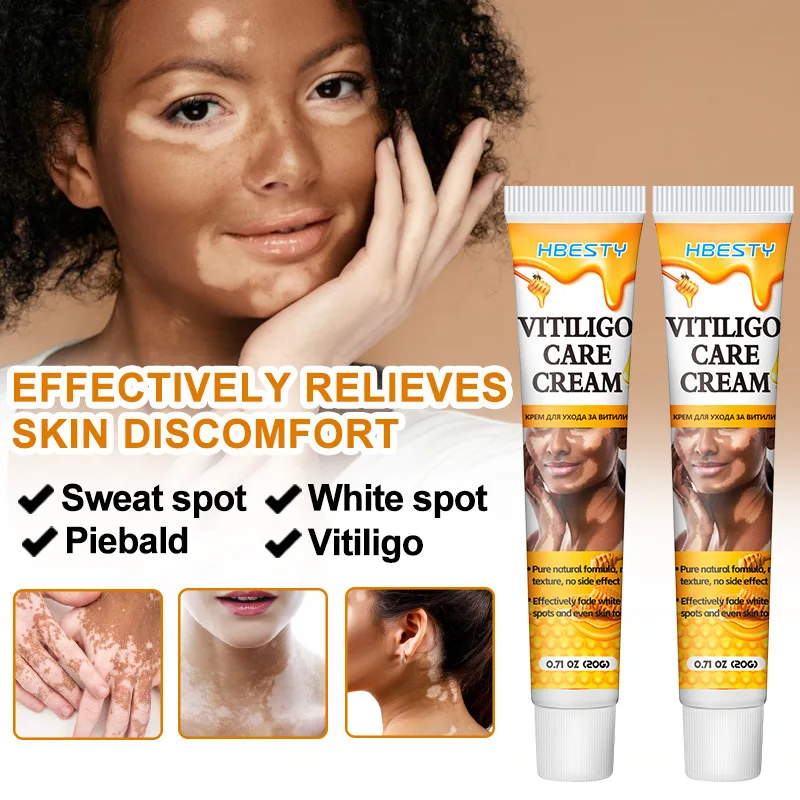 HBESTY Effectively Remove Vitiligo Ointment Remove Ringworm White Spot and Vitiligo Skin Care Product