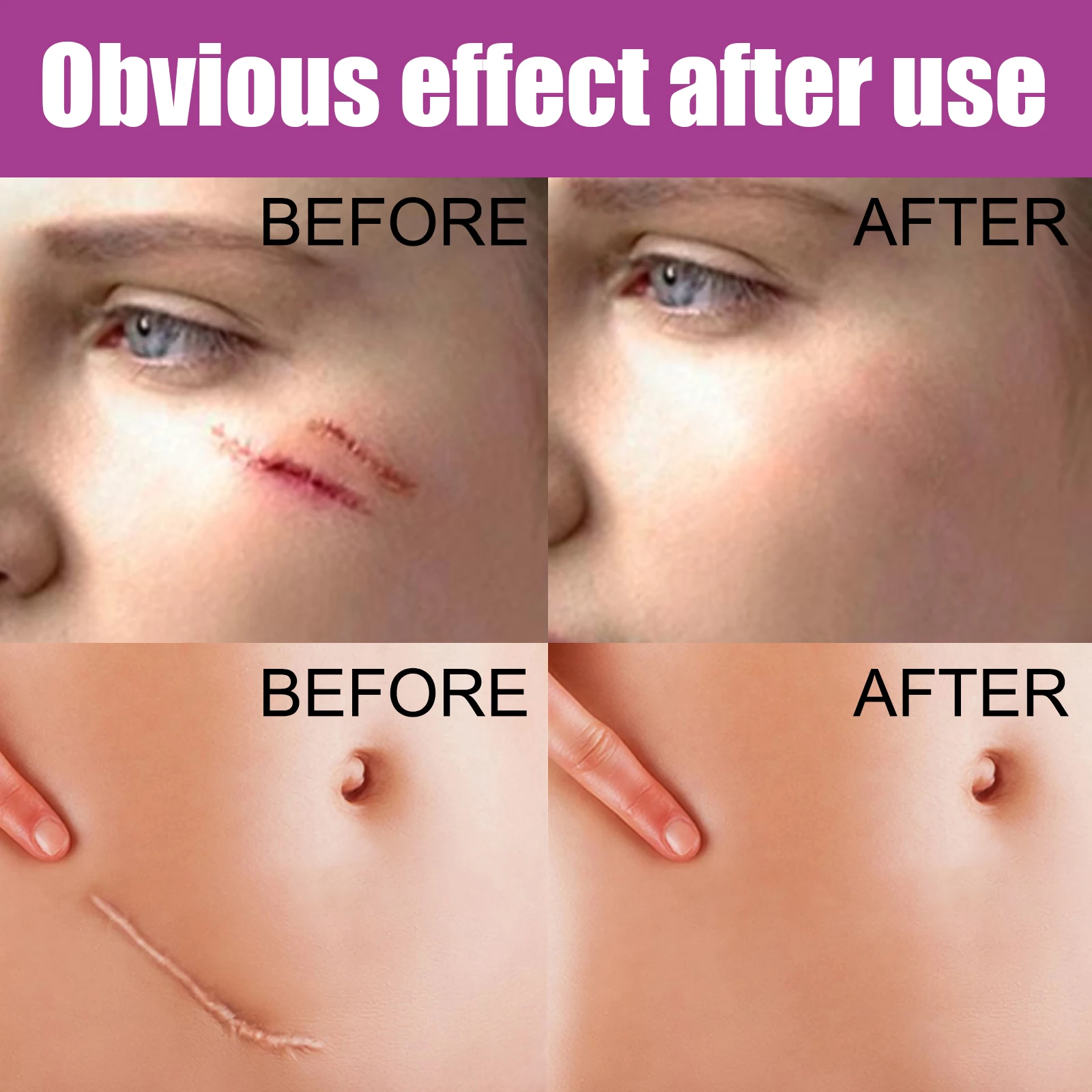 Amazon hot selling acne scar treatment ointment scar removal cream for surgical acne  scald scar