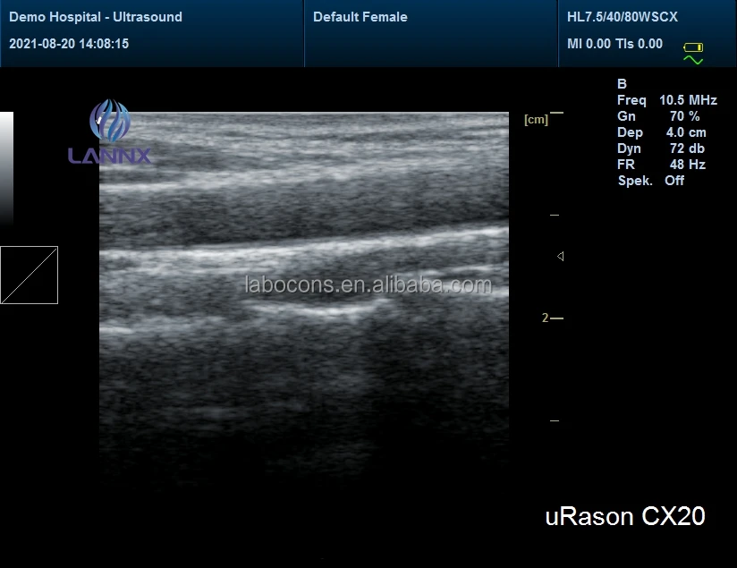 LANNX uRason CX20 Hot selling portable ultrasound 128 elements 2D/3D color doppler ultrasound for hospital ultrasonido portatil