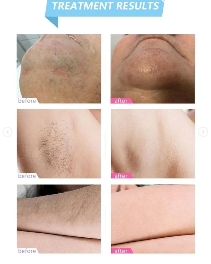 Beauty Medical Equipment 808nm Diode Laser Hair Removal Machine for All Skin Type USA Laser Bar Yag Laser Hair Removal Equipment