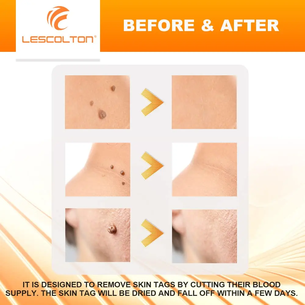 Orange Set Skin Tags Removal Kit Home Use Mole Wart Remover Equipment Micro Skin Tag Treatment Tool Easy To Clean Skin Care Tool