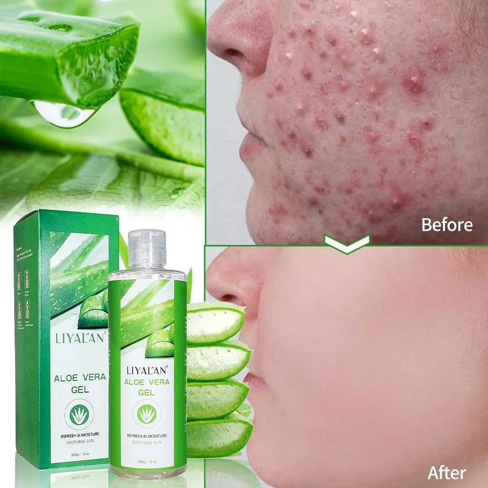 Oem Private Label Face Care 100% Natural Organic Aloe Vera Extract Sunburn Soothing Aloe Vera Gel