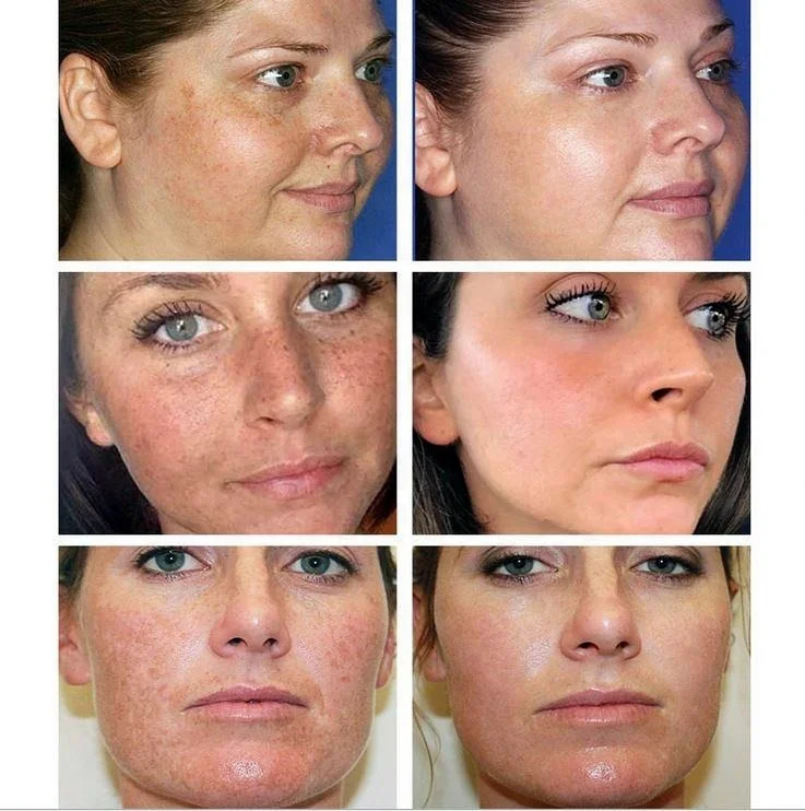 Pimples Melasma Blemish Removal Dark Spot Remover Cream Strong Bleaching Whitening Face Freckles Remove Corrector Cream