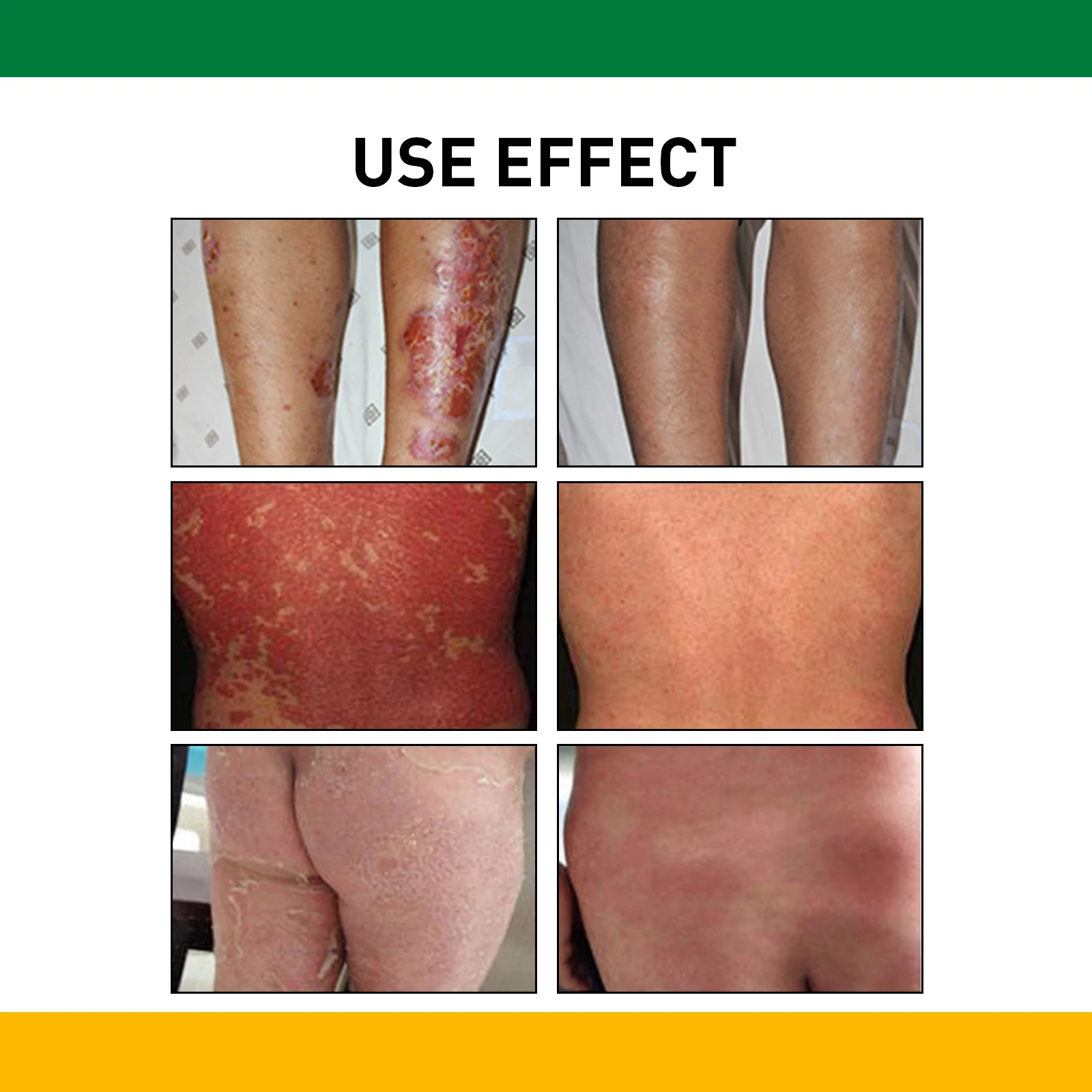 Custom logo Herbal Bacteriostatic Cream Psoriasis Dermatitis Ointment Anti-itching Skin Problems Antifungal Cream