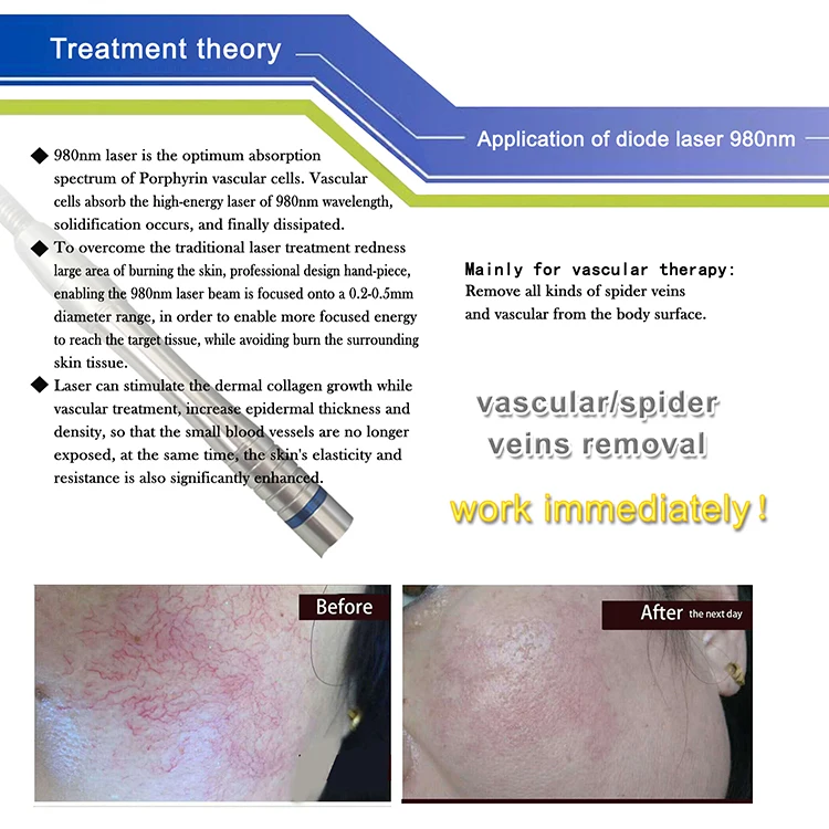 Very effective 980nm laser vascular removal / spider vein remove machine / fiber diode red vein treatment equipment