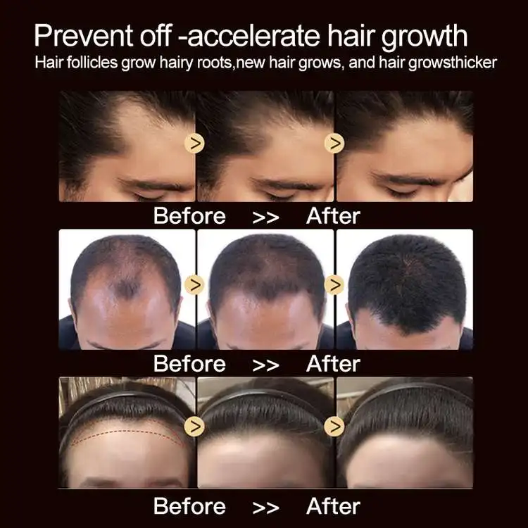 Private Label Batana Oil Organic Hair Regrowth 100% Natural Gginger Promote Hair Growth Shampoo OEM