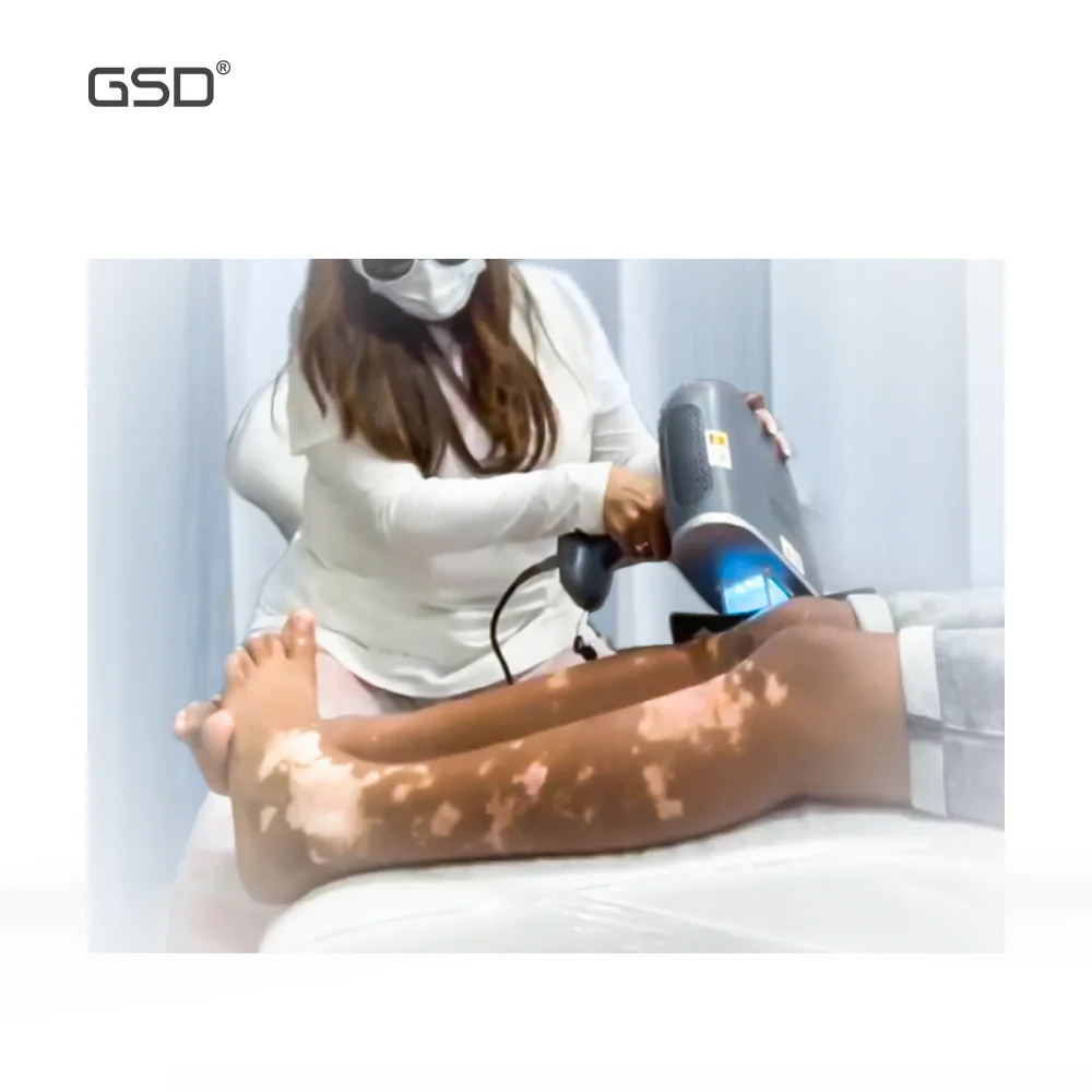 GSD 2020 New Mini 308nm Excimer Laser Uv Lamp For Psoriasis
