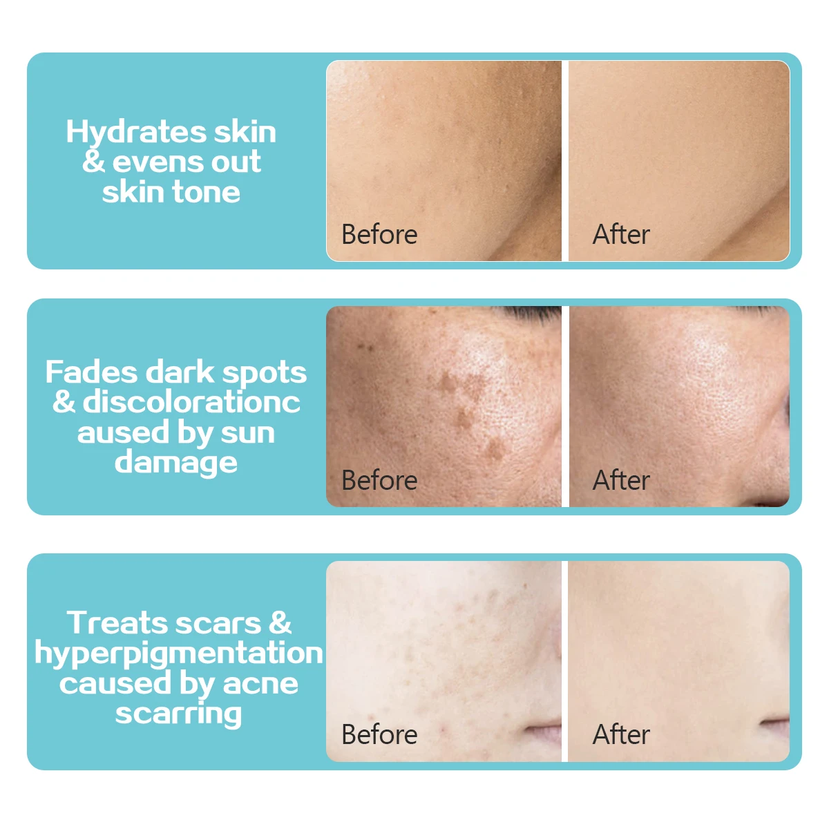 Squalane Discoloration Acne Scars Alpha Arbutin Treats Dark Spot Corrector Glow Lightening Whitening Skin Care Kojic Acid Serum