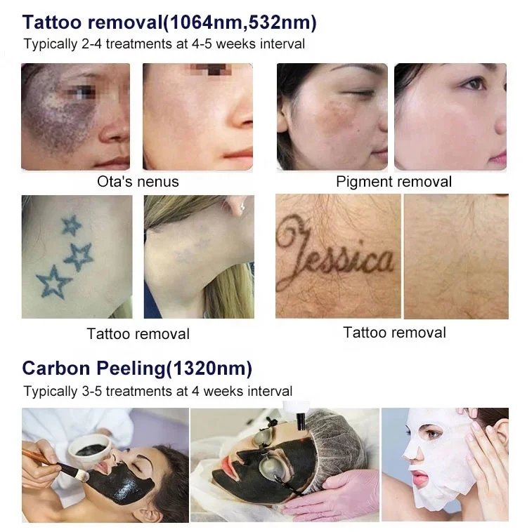 New q switch nd yag laser permanent tattoo removal q-switch laser machine for tattoo removal