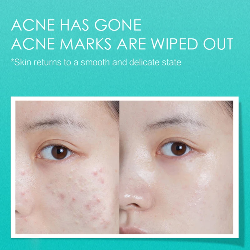 Enhances brightness herbal essence acne scar removal cream deep acne scar removal stretch mark cream oil control anti acne cream