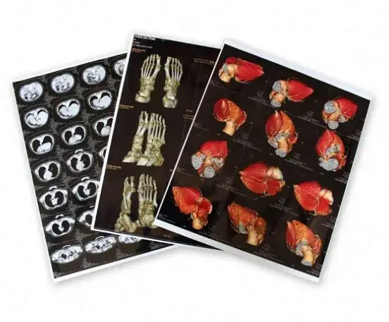 11X14inch High definition medical white film that can be viewed directly No need for film viewing lights  for PANTUM Printer