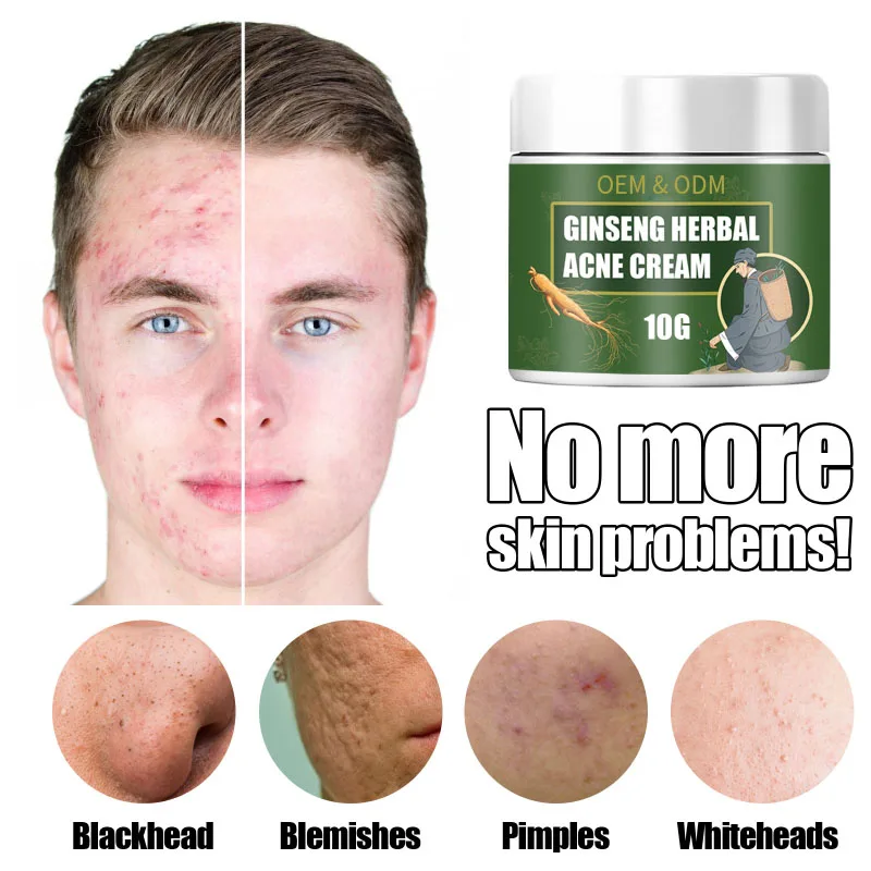 Facial Skin Care vitamin E Cream Anti-Acne  Acne Scar Removal Natural Herbal Extract Herbal Acne Removing Cream