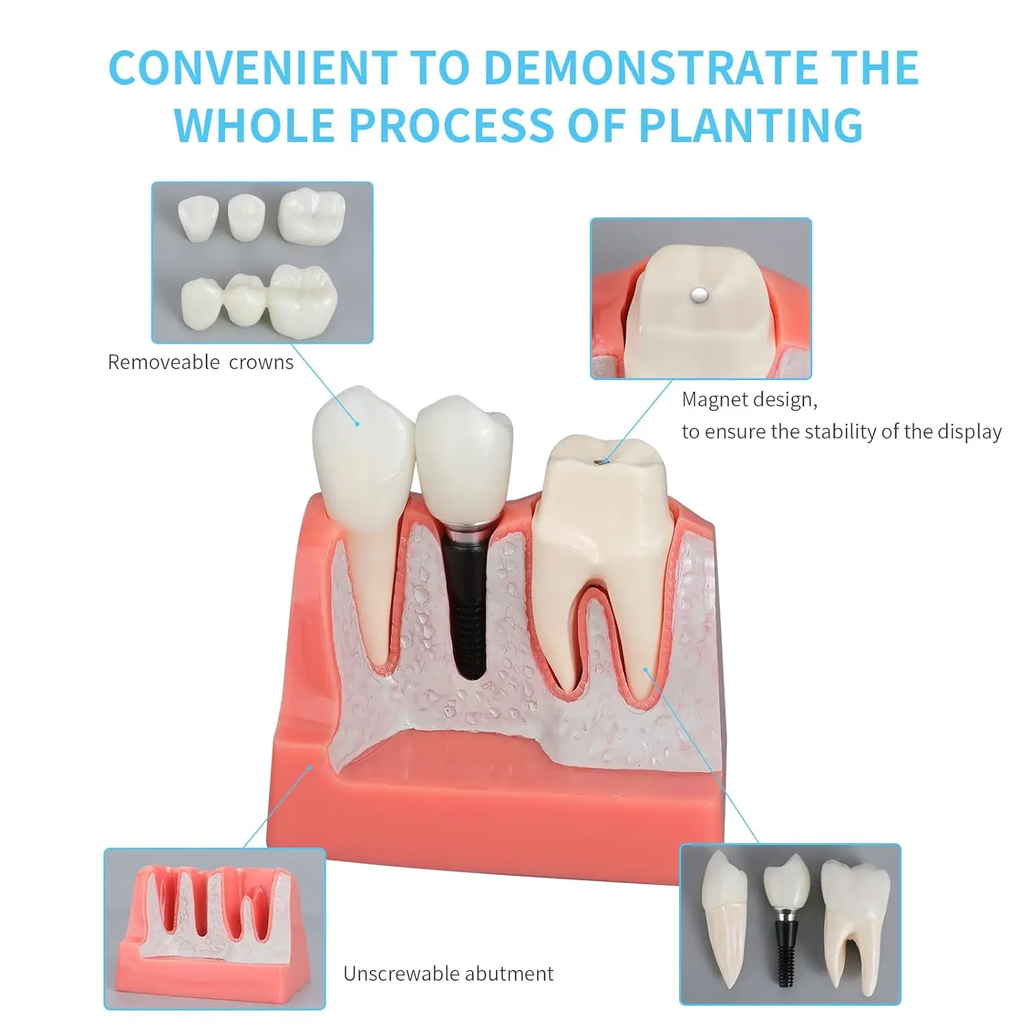 Dental Implant Model with Removable Analysis Crown Bridge Demonstration Teeth 4 Times for Medical Science Education Studying